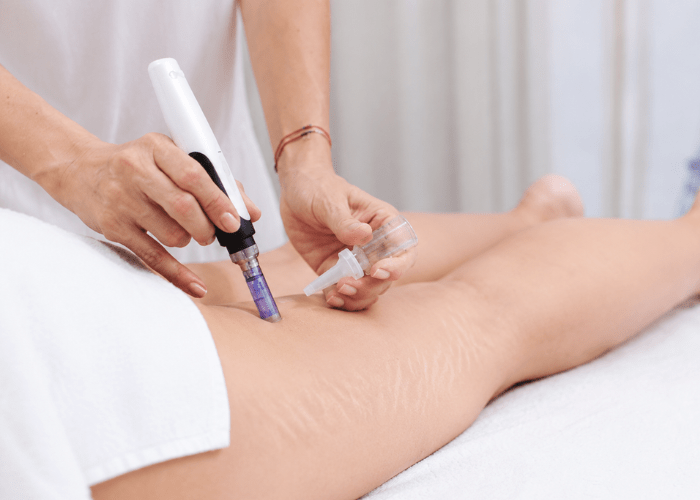 Microneedling for Deeper Improvement